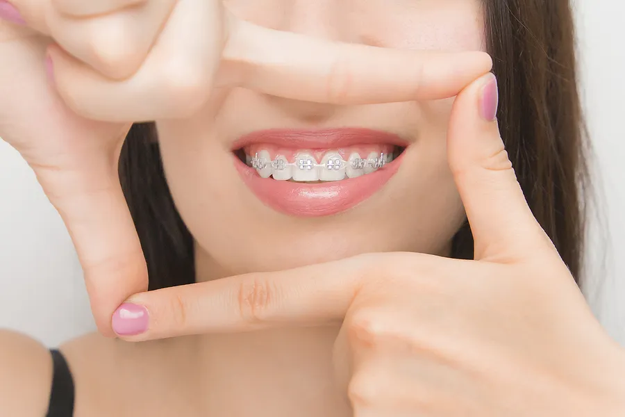 Braces in the New Year Can Give You a Straighter Smile You Have Always Wanted!