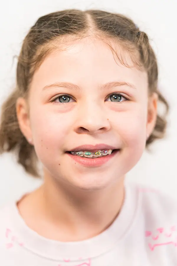 Brushing and Flossing Routines for Braces Wearers: How to Maintain Oral Health During Orthodontic Treatment