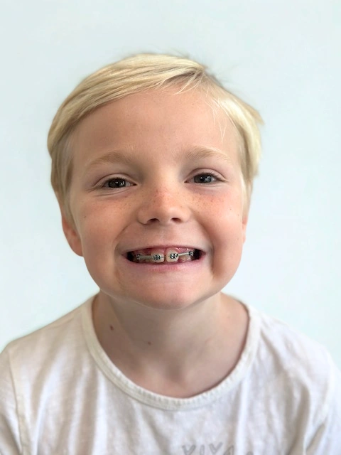 Early Orthodontic Treatment